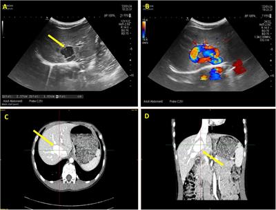 Case Report: Management of a congenital intrahepatic portosystemic shunt with portal vein aneurysm in a child using 3D computer-assisted partial right hepatectomy